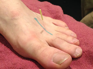 MR Podiatry dry needling feet treatment